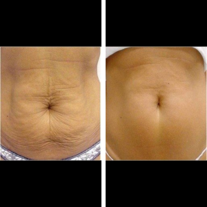 Skin Tightening Results