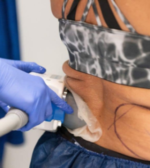 Coolsculpting