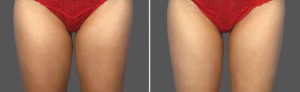 Coolsculpting results