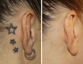 Tattoo Removal