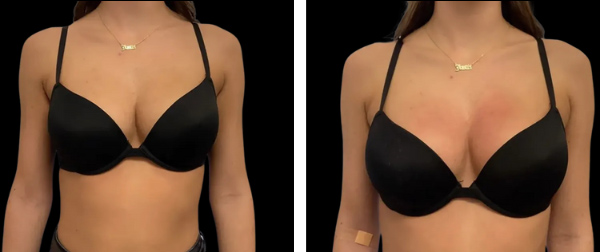 Beautifill fat transfer in woman
