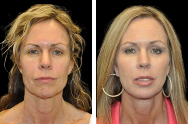 Beautifill fat transfer in woman