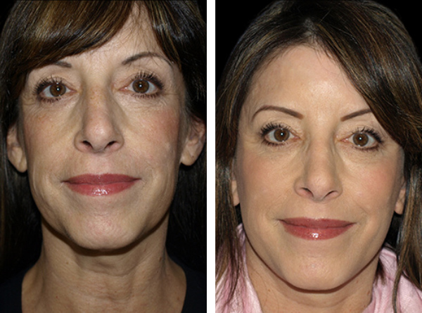 Beautifill fat transfer in woman