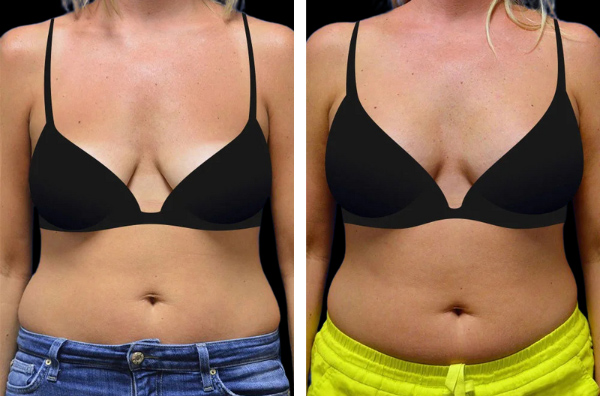 Beautifill fat transfer in woman