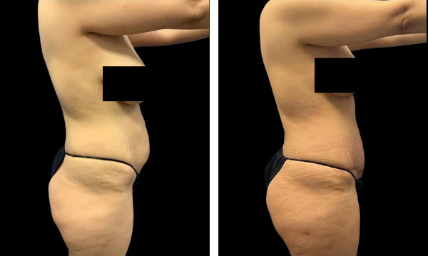 Beautifill fat transfer in woman