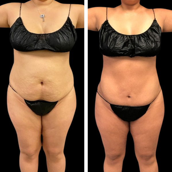 Beautifill liposuction results in woman