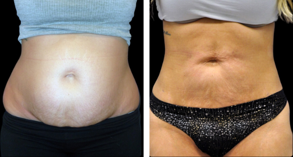 Beautifill liposuction results in woman