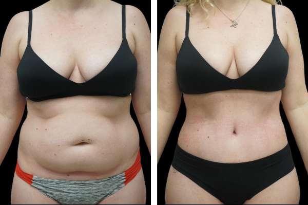 Beautifill liposuction results in woman
