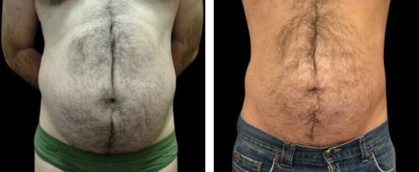 Beautifill liposuction results in man
