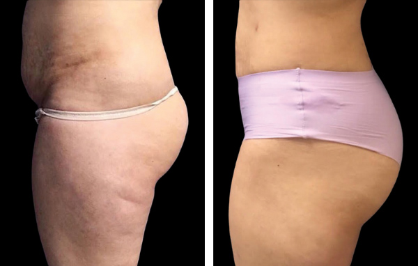 Beautifirm skin tightening results in woman