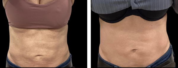 Beautifirm skin tightening results in woman