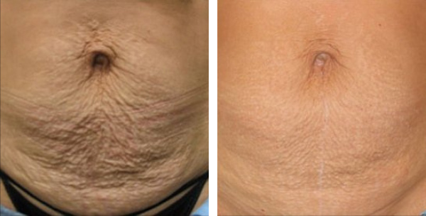 Beautifirm skin tightening results in woman