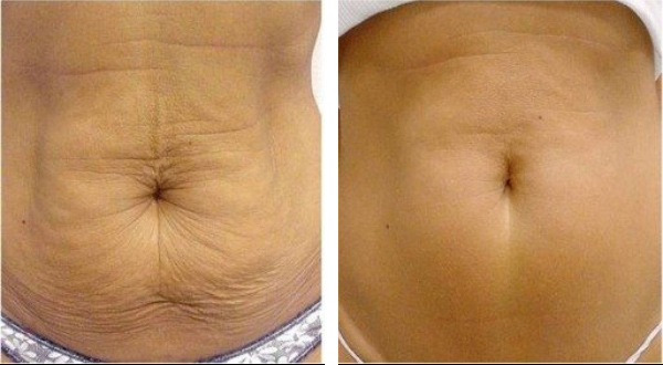 Beautifirm skin tightening results in woman