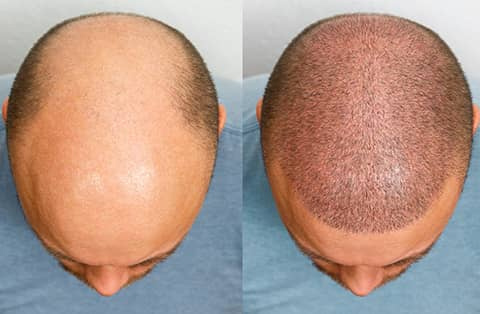 Hair transplant in man