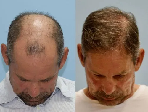 Hair transplant in man