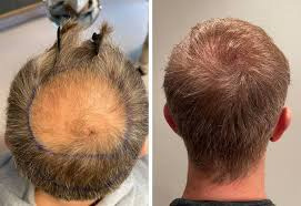 Hair transplant in man