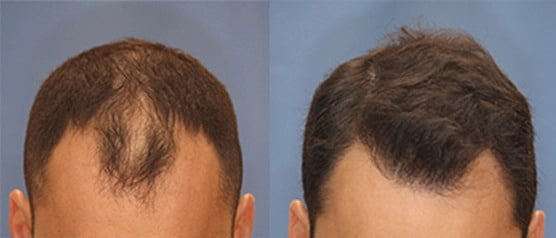 Hair transplant in man