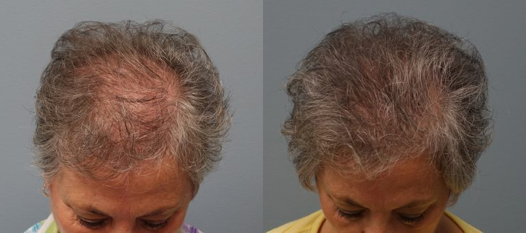 Hair transplant in woman