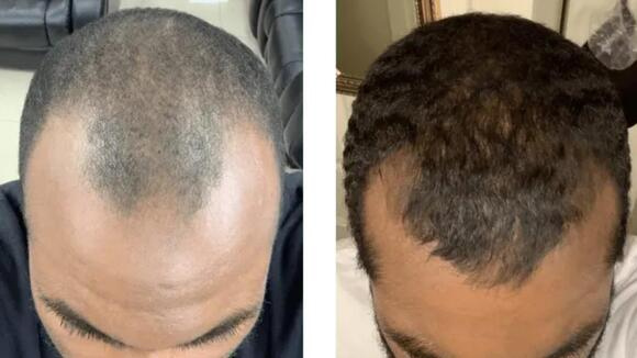 Hair transplant in man
