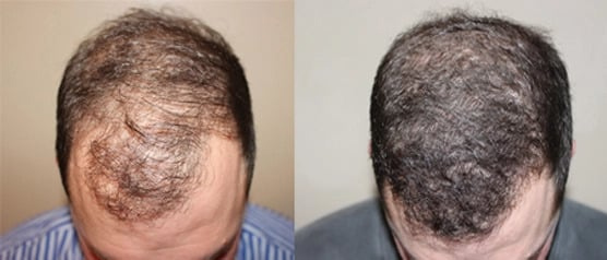Hair transplant in man