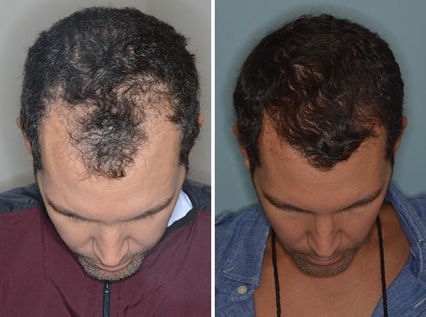 Hair transplant in man