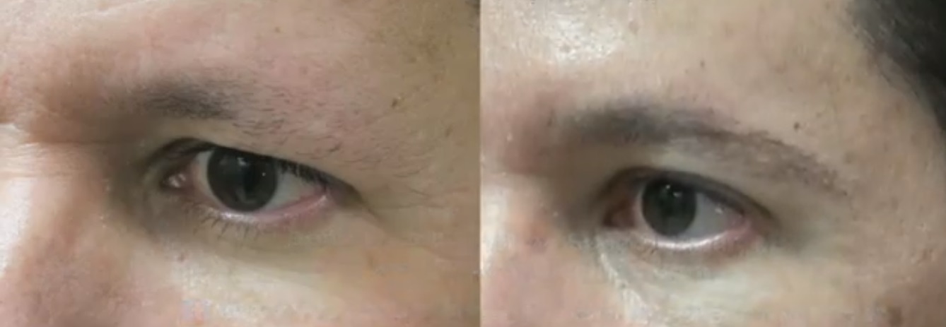 TED eyebrow in woman