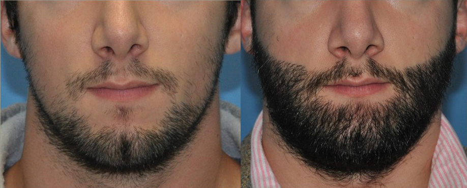 TED facial hair in a man