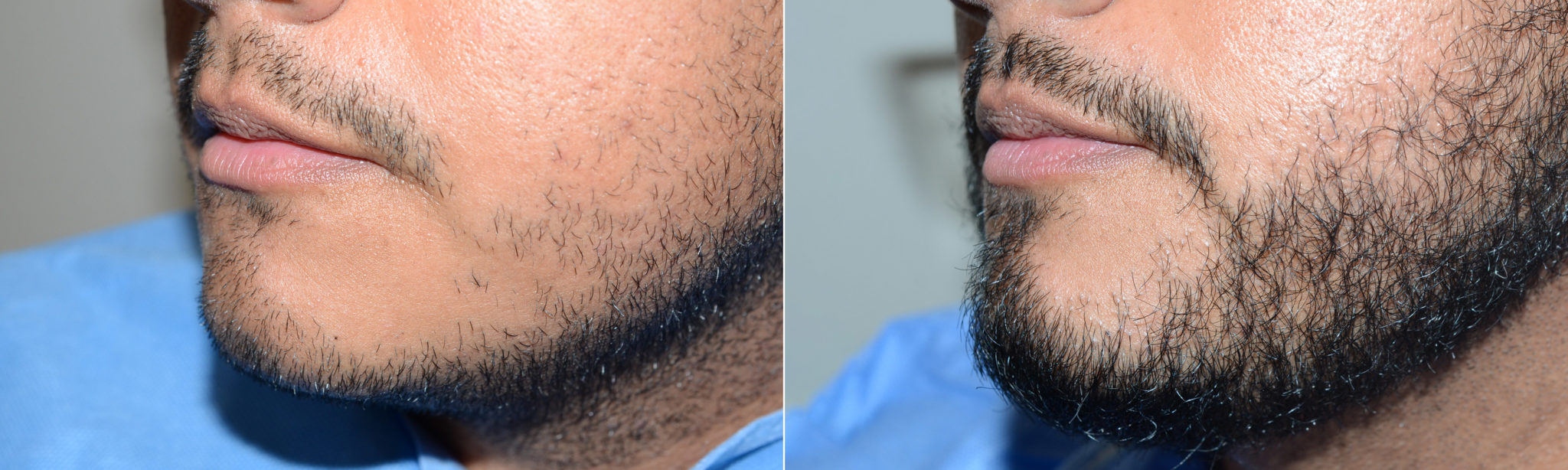 TED facial hair in a man