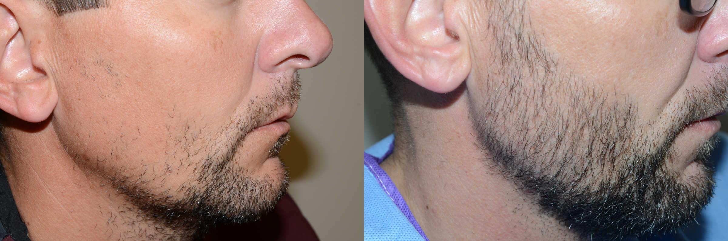 Laser hair removal pubic area