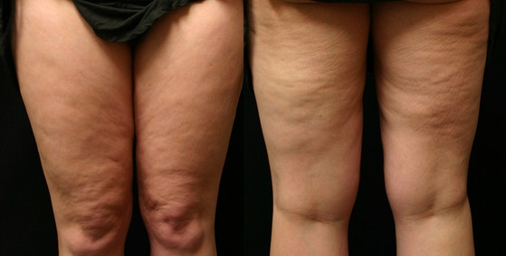 Cellulite removal