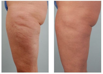 Cellulite removal