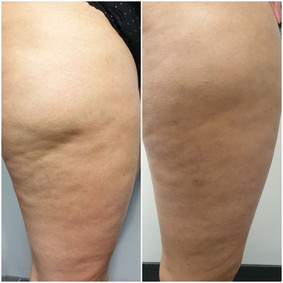 Cellulite removal