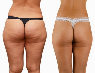 Cellulite removal
