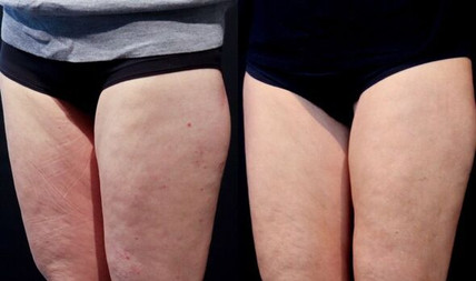 Cellulite removal