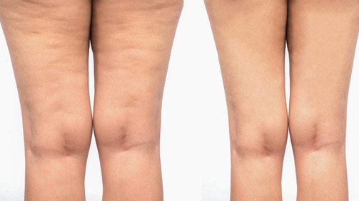 Cellulite removal