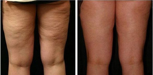 Cellulite removal