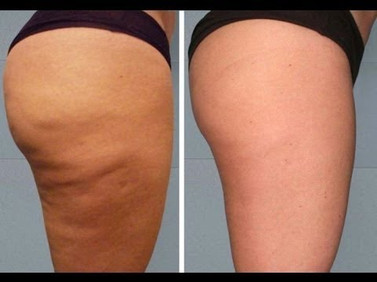 Cellulite removal