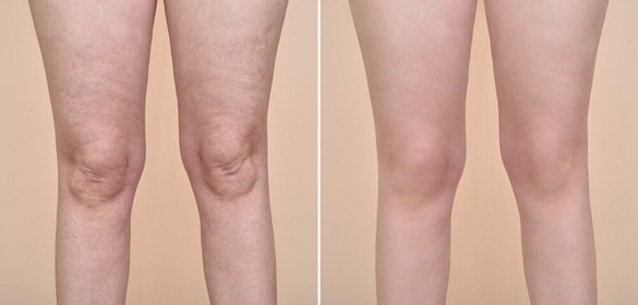 Cellulite removal