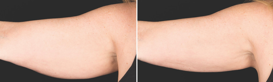 Cool sculpting results in woman