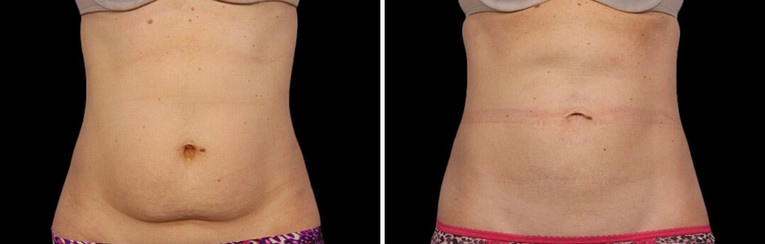 Cool sculpting results in woman