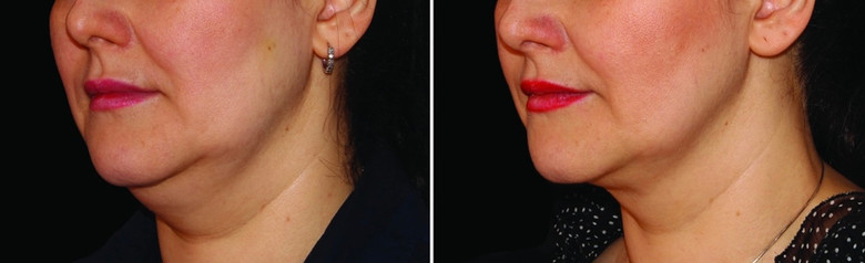 Cool sculpting results in woman