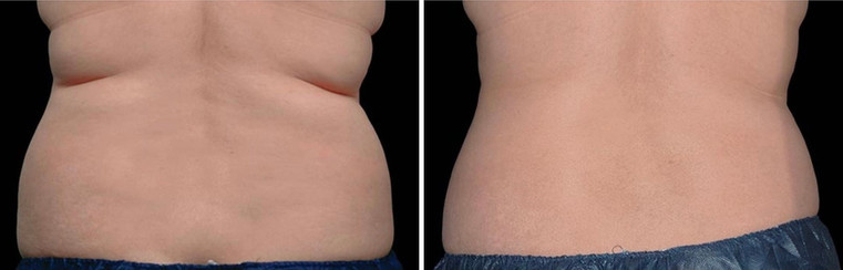 Cool sculpting results in woman