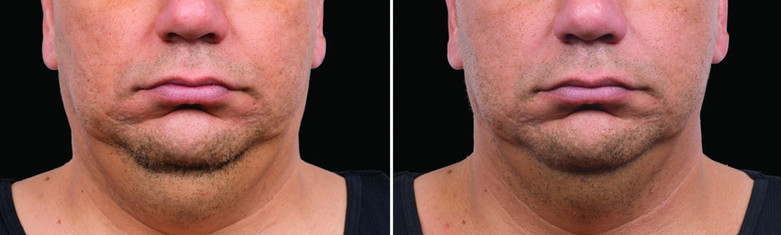 Cool sculpting results in man