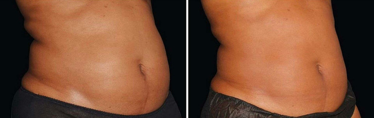Cool sculpting results in woman