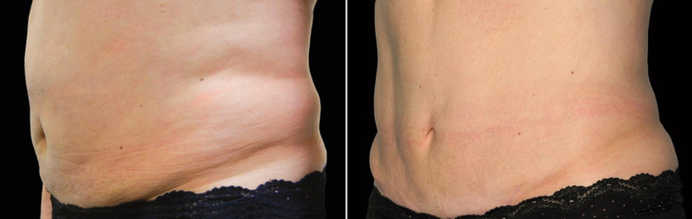 Cool sculpting results in woman