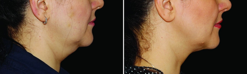 Cool sculpting results in woman