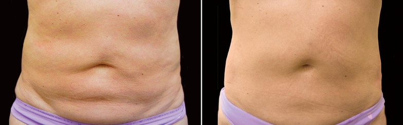 Cool sculpting results in woman
