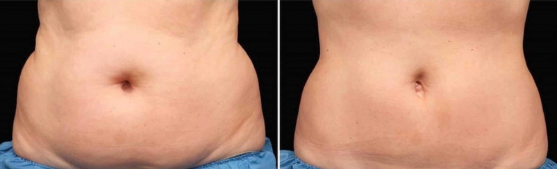 Cool sculpting results in woman