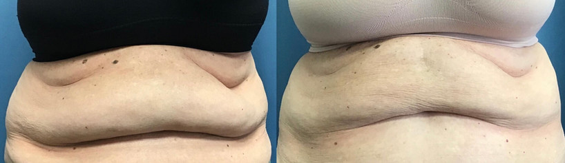 Cool sculpting results in woman
