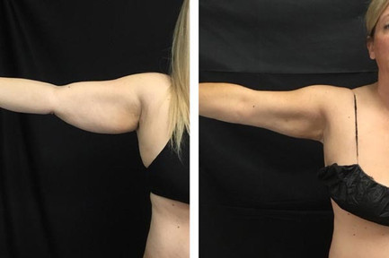 Cool sculpting results in woman